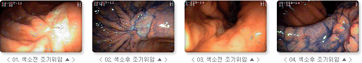 관련 사진 : 01. 색소전 조기위암, 02. 색소 후 조기 위암, 03. 색소전 조기위암, 04. 색소 후 조기 위암