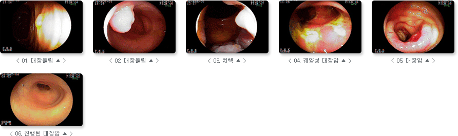 관련 사진 : 01. 색소 전 대장궤양사진, 02. 색소 후 대장궤양사진,03. 색소 전 대장 폴립사진, 04. 색소 후 대장 폴립사진