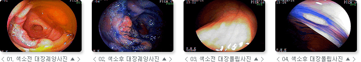 관련 사진 : 01. 색소 전 대장궤양사진, 02. 색소 후 대장궤양사진,03. 색소 전 대장 폴립사진, 04. 색소 후 대장 폴립사진