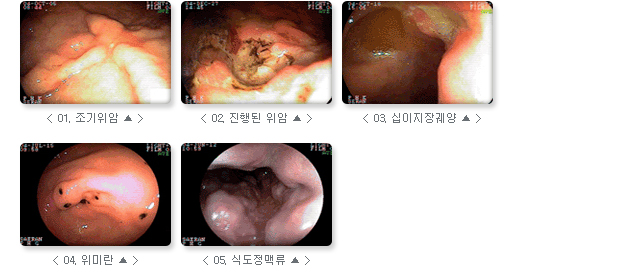 관련 사진 : 01. 조기위암, 02. 진행된 위암, 03. 십이지장퀘양, 04. 위미란, 05. 식도정맥류