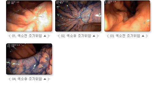 관련 사진 : 01. 색소전 조기위암, 02. 색소 후 조기 위암, 03. 색소전 조기위암, 04. 색소 후 조기 위암