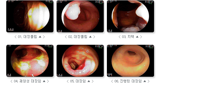 관련 사진 : 01. 색소 전 대장궤양사진, 02. 색소 후 대장궤양사진,03. 색소 전 대장 폴립사진, 04. 색소 후 대장 폴립사진