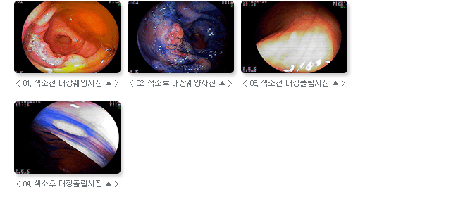 관련 사진 : 01. 색소 전 대장궤양사진, 02. 색소 후 대장궤양사진,03. 색소 전 대장 폴립사진, 04. 색소 후 대장 폴립사진