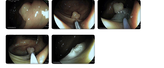 관련 사진 : 대장용종 사진